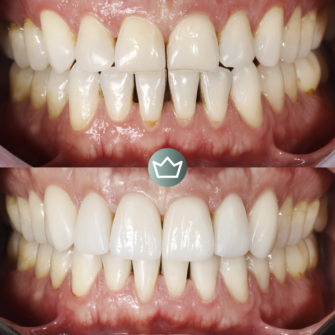 Antes e depois sartori (2)